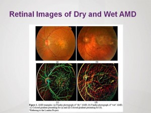 ARIA - Retinal Images of Dry and Wet AMD